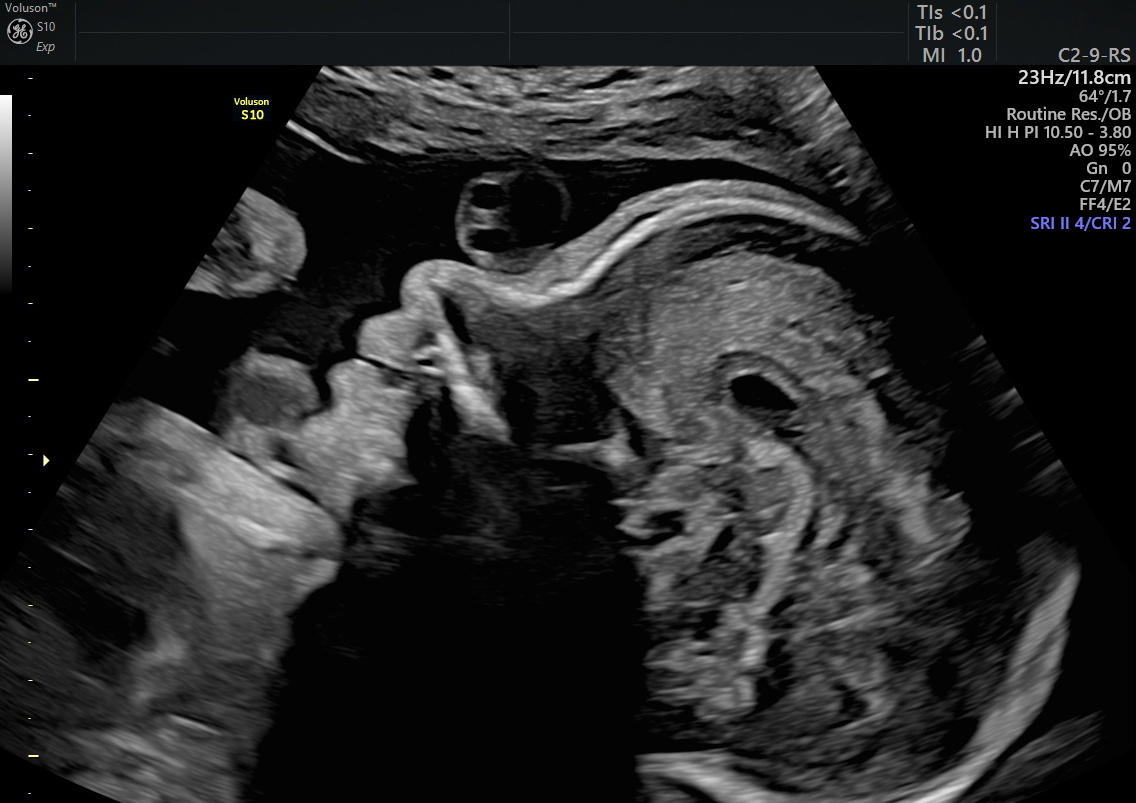 Baby Scan