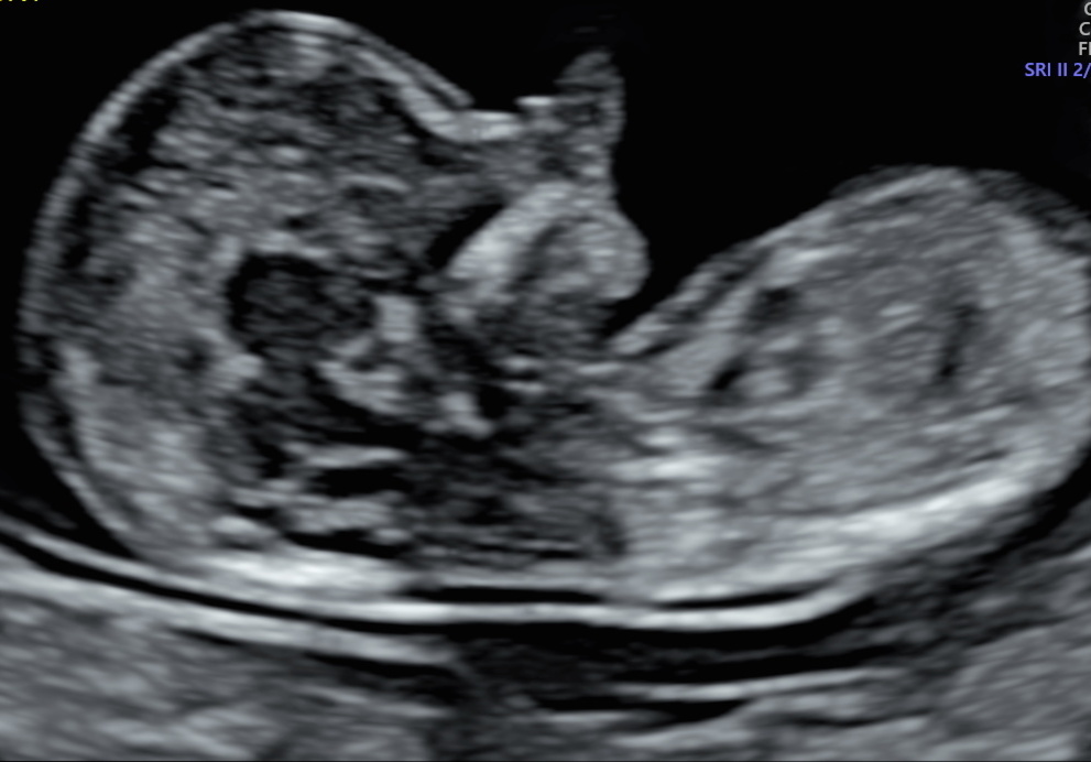 Baby Scan